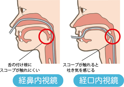 経鼻内視鏡 経口内視鏡