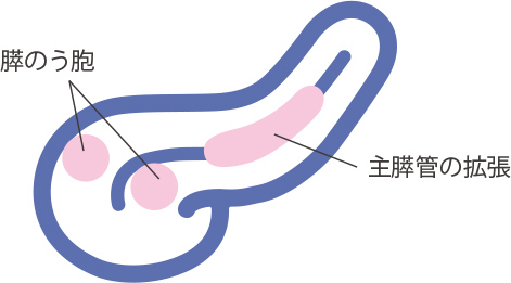 すい臓がんリスク検査